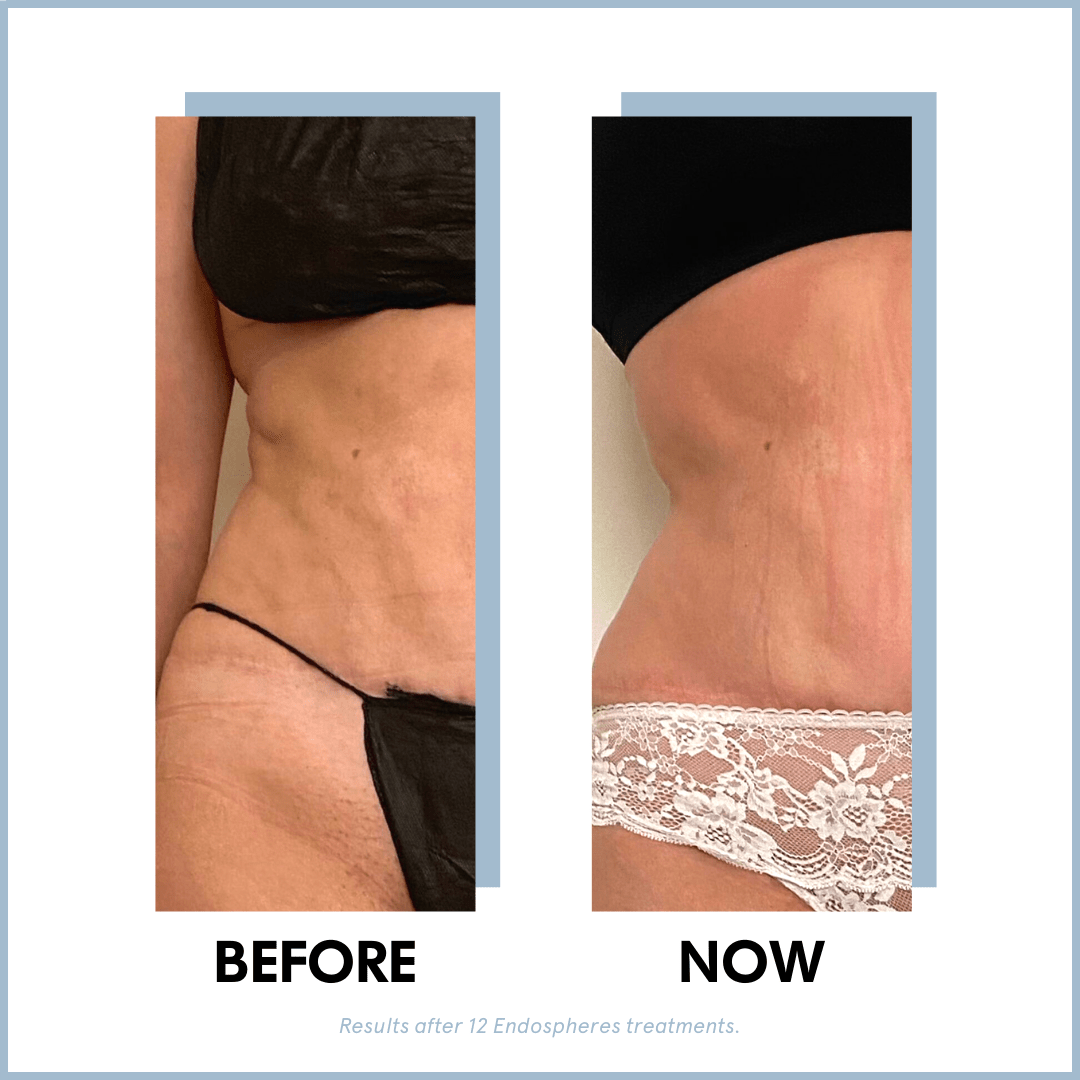 Endosphéres Therapy Package